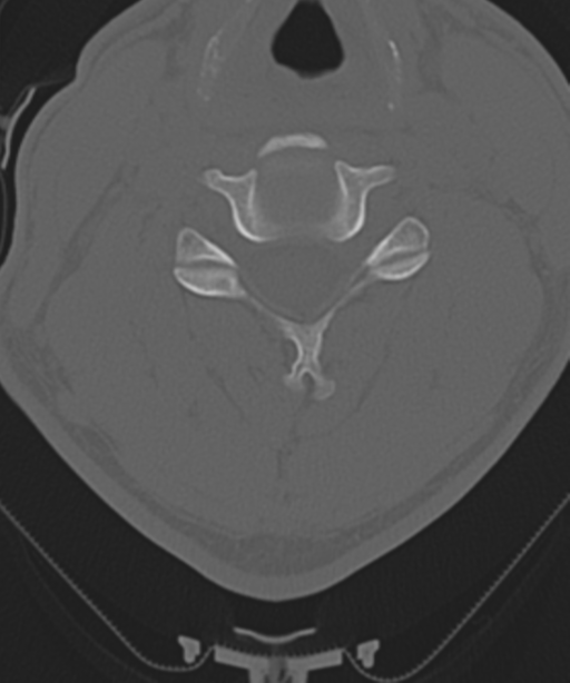 Cervical intercalary bone (Radiopaedia 35211-36748 Axial bone window 35).png