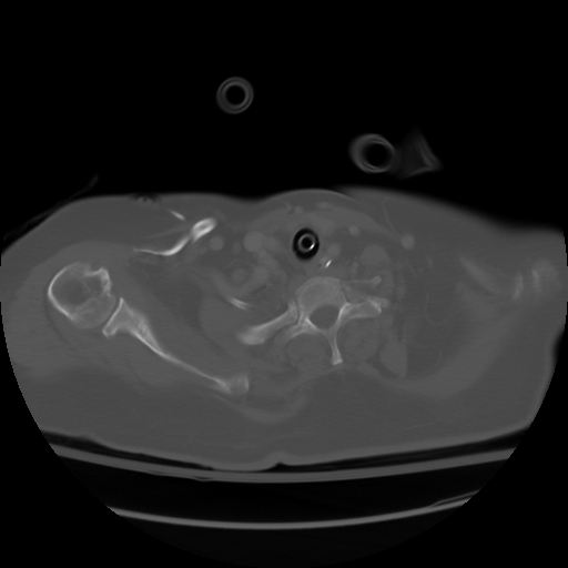 File:Cervical rib (Radiopaedia 8717-9525 Axial bone window 6).jpg