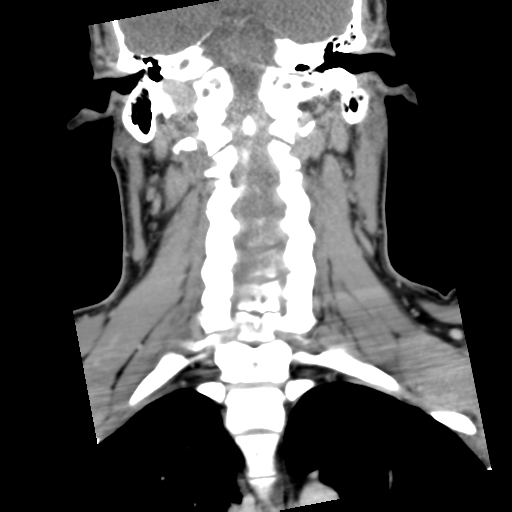 Cervical schwannoma (Radiopaedia 57979-64974 G 33).png