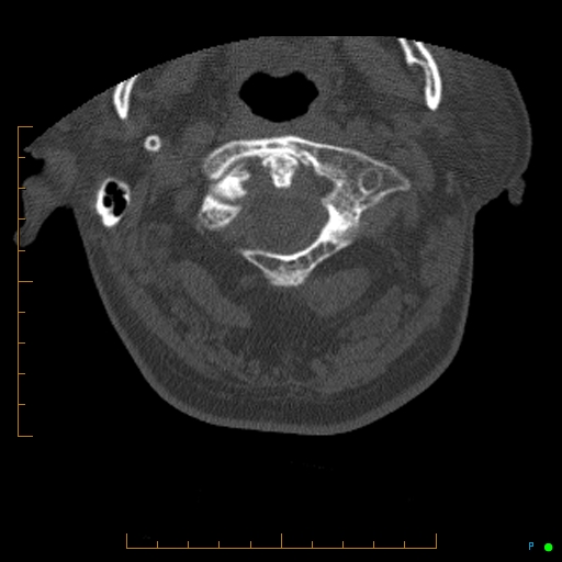 Cervical spine fracture - ankylosing spondylitis (Radiopaedia 76835-88706 Axial bone window 24).jpg