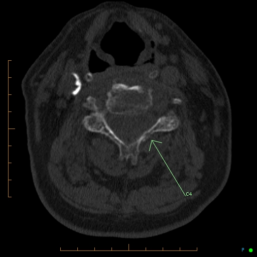 File:Cervical spine fracture - ankylosing spondylitis (Radiopaedia 76835-89037 KEY IMAGES ARROWS 3).jpg