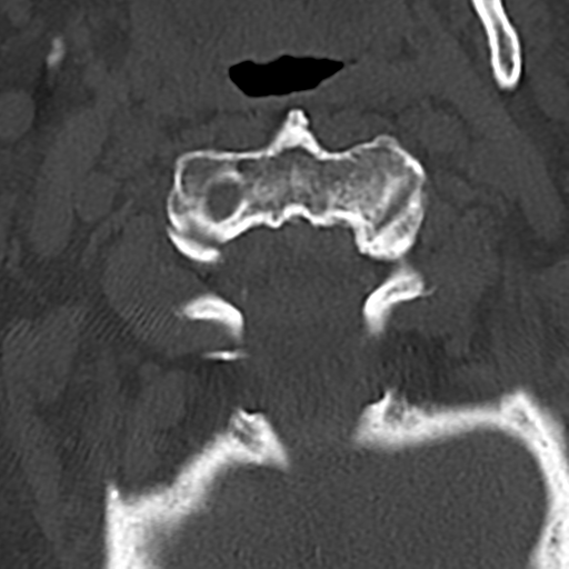 File:Cervical spine fracture - chalk stick (Radiopaedia 39116-41323 Axial bone window 20).png