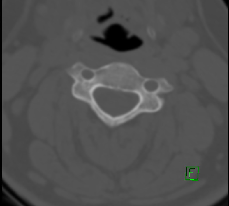 Cervical spine fracture - hyperflexion injury (Radiopaedia 66184-75364 Axial bone window 15).jpg