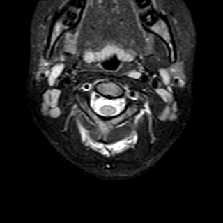 File:Cervical spine posterior ligamentous complex rupture (Radiopaedia 63486-72103 Axial T2 19).jpg