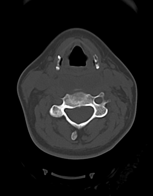 Cervical tuberculous spondylitis (Radiopaedia 39149-41365 Axial bone window 26).png