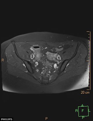 File:Cesarian scar endometriosis (Radiopaedia 68495-78066 Axial T1 C+ fat sat 8).jpg