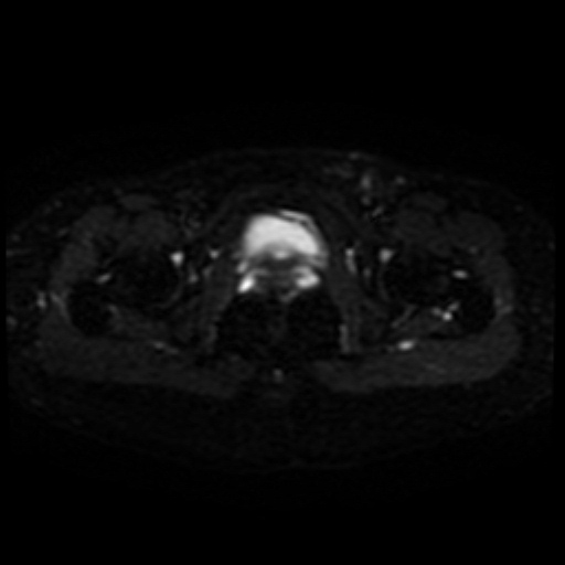 File:Cesarian section scar endometriosis (Radiopaedia 66520-75799 Axial DWI 21).jpg