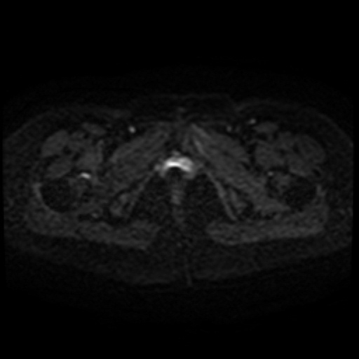 File:Cesarian section scar endometriosis (Radiopaedia 66520-75799 Axial DWI 49).jpg