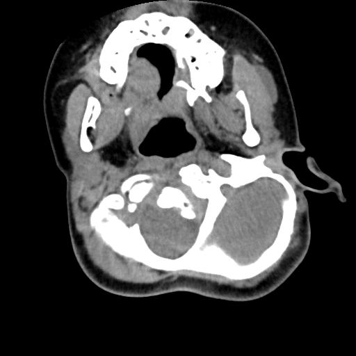 Chiari I with syrinx and skull base anomalies (Radiopaedia 89444-106412 Axial non-contrast 43).jpg