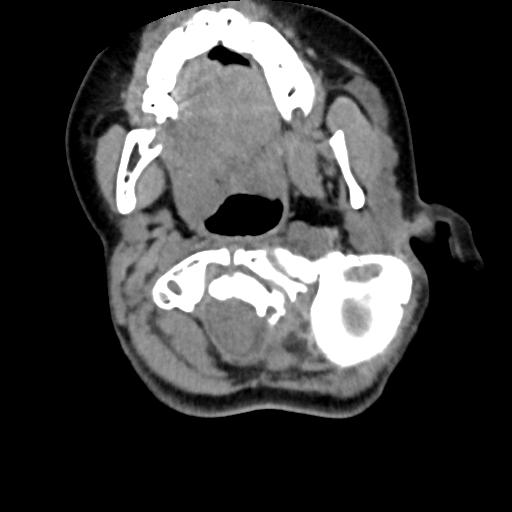 Chiari I with syrinx and skull base anomalies (Radiopaedia 89444-106412 Axial non-contrast 51).jpg