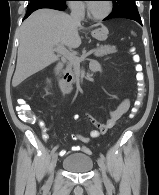 Cholecystitis with focal perforation and hepatic abscess (Radiopaedia 37189-38945 Coronal non-contrast 27).png