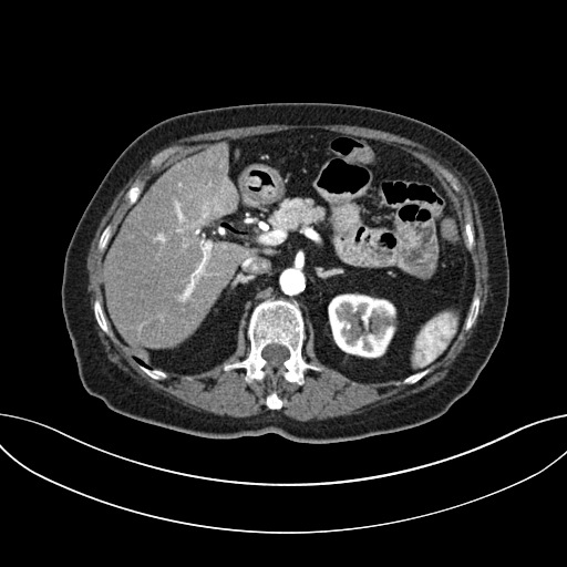 Cholecystoduodenal fistula due to calculous cholecystitis with gallstone migration (Radiopaedia 86875-103077 A 24).jpg