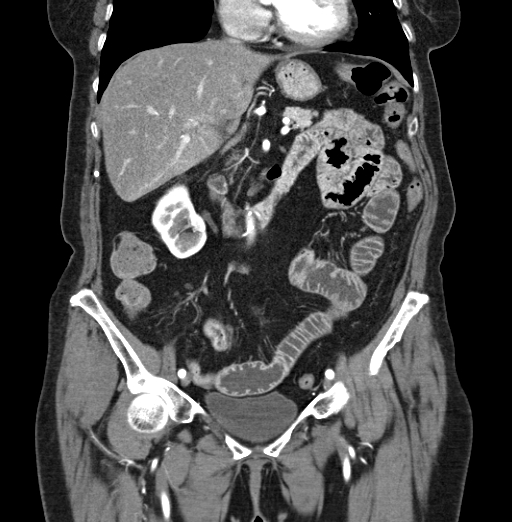 File:Cholecystoduodenal fistula due to calculous cholecystitis with gallstone migration (Radiopaedia 86875-103077 B 21).jpg