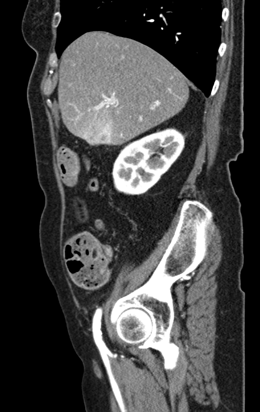 Cholecystoduodenal fistula due to calculous cholecystitis with gallstone migration (Radiopaedia 86875-103077 C 46).jpg