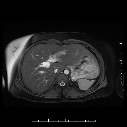 File:Choledochal cyst with chronic calcific pancreatitis (Radiopaedia 18245-18062 Axial T2 3).png