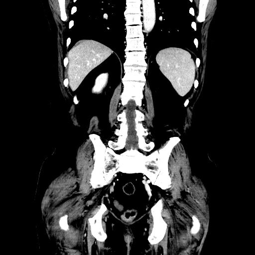Choledocholiathiasis with normal caliber common bile duct (Radiopaedia 75368-86632 Coronal liver window 92).jpg