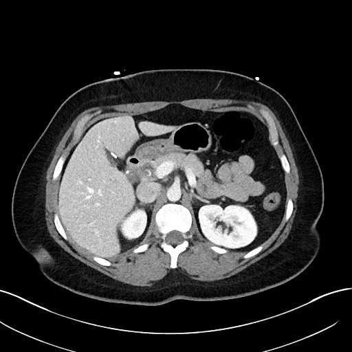 File:Choledocholithiasis after recent cholecystectomy (Radiopaedia 60929-68737 Axial 27).jpg