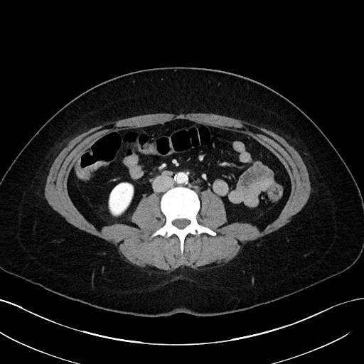 File:Choledocholithiasis after recent cholecystectomy (Radiopaedia 60929-68737 Axial 5).jpg