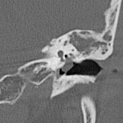 File:Cholesteatoma (Radiopaedia 9408-10093 Coronal bone window 5).jpg