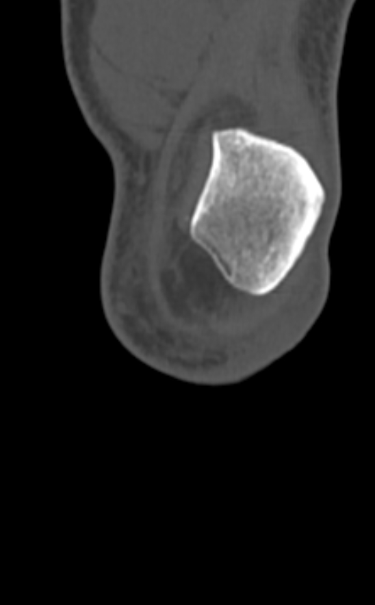 Chondrocalcinosis (Radiopaedia 82862-97173 Coronal bone window 10).jpg