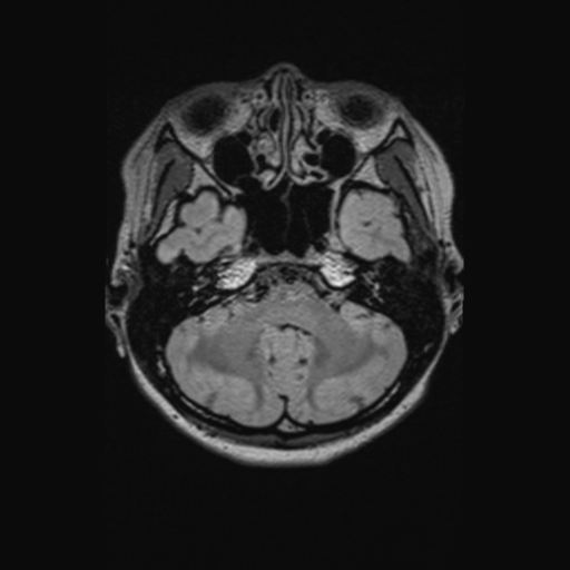 Chondrosarcoma (Radiopaedia 41937-44939 Axial FLAIR 34).png