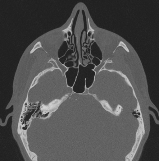 Chondrosarcoma (clivus) (Radiopaedia 46895-51425 Axial bone window 41).png