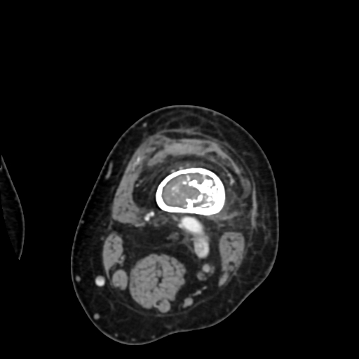 File:Chondrosarcoma - femur (Radiopaedia 64187-72954 Axial with contrast 23).jpg