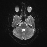 File:Chondrosarcoma - sphenoid wing (Radiopaedia 58259-67947 Axial DWI 6).jpg