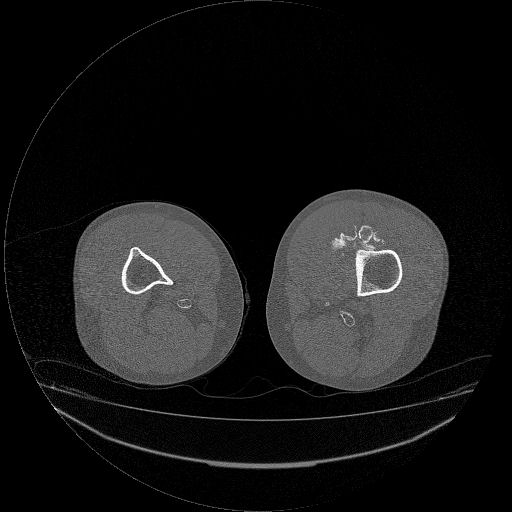 File:Chondrosarcoma arising from exostosis (Radiopaedia 59996-67507 Axial bone window 22).jpg