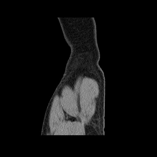Chondrosarcoma of iliac wing (Radiopaedia 63861-72599 F 170).jpg