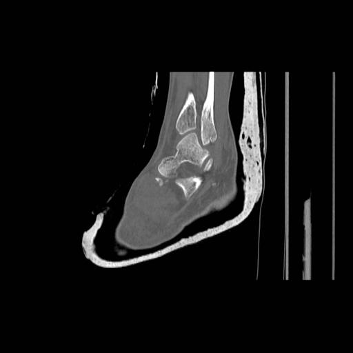 File:Chopart fracture (Radiopaedia 12386-12650 Sagittal bone window 1).jpg