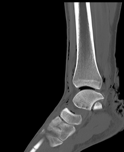File:Chopart fracture (Radiopaedia 35347-36851 Sagittal bone window 30).jpg
