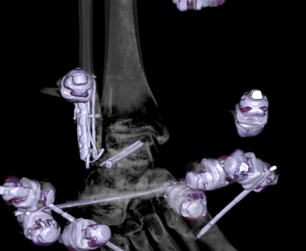 File:Chopart fracture (Radiopaedia 35347-36861 3D MPR bone window 22).jpg