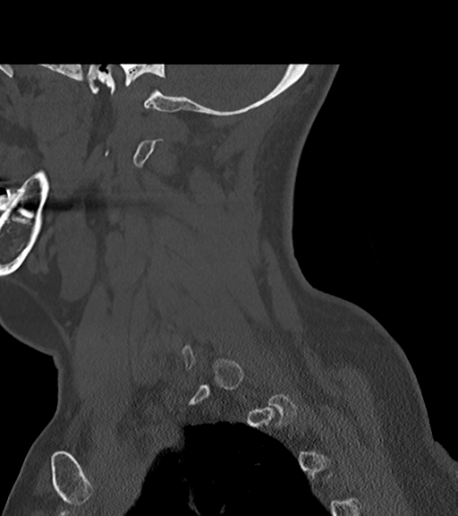 File:Chordoma (C4 vertebra) (Radiopaedia 47561-52188 Sagittal bone window 18).png