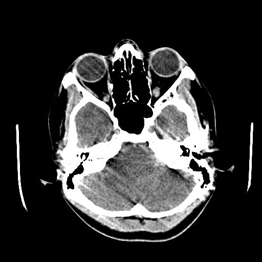File:Choriocarcinoma of ovary with cerebral and pulmonary metastases (Radiopaedia 25983-26118 C+ arterial phase 27).jpg