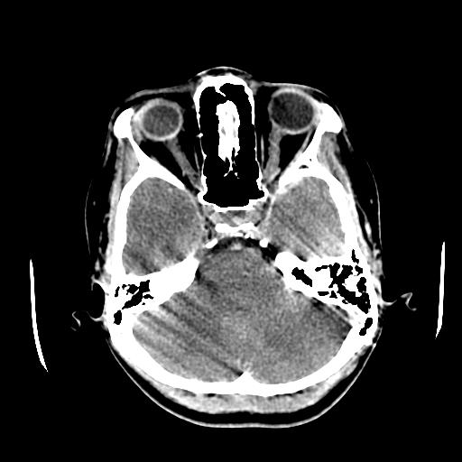 File:Choriocarcinoma of ovary with cerebral and pulmonary metastases (Radiopaedia 25983-26118 C+ arterial phase 38).jpg