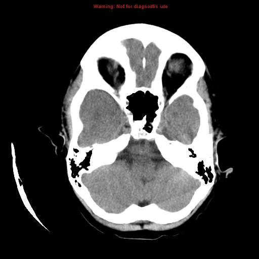 File:Choroid plexus carcinoma - recurrent (Radiopaedia 8330-9168 Axial non-contrast 5).jpg