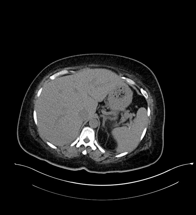 Chromophobe renal cell carcinoma (Radiopaedia 84239-99519 Axial non-contrast 43).jpg