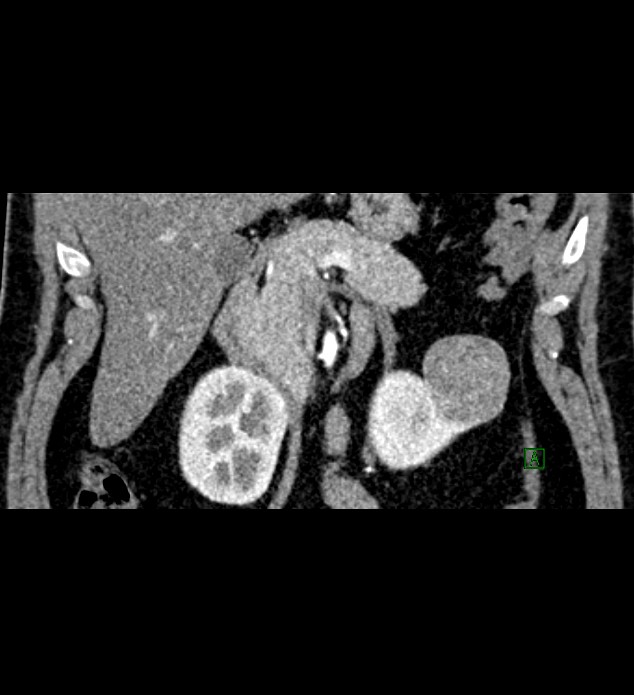 Chromophobe renal cell carcinoma (Radiopaedia 84286-99573 E 21).jpg