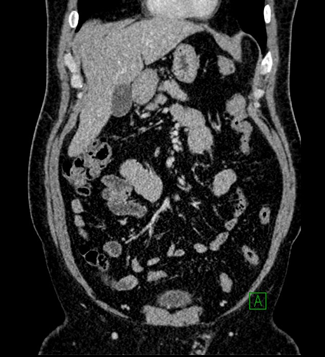 Chromophobe renal cell carcinoma (Radiopaedia 84286-99573 H 56).jpg