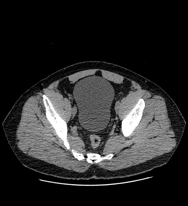 Chromophobe renal cell carcinoma (Radiopaedia 84337-99693 Axial non-contrast 136).jpg
