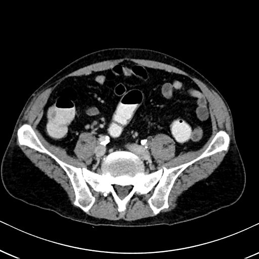 Chronic appendicitis complicated by appendicular abscess, pylephlebitis and liver abscess (Radiopaedia 54483-60700 B 105).jpg