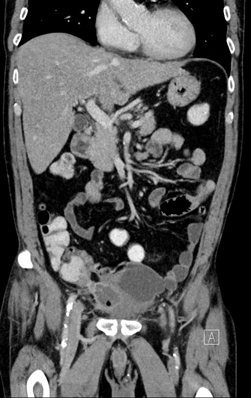 Chronic appendicitis complicated by appendicular abscess, pylephlebitis and liver abscess (Radiopaedia 54483-60700 C 32).jpg