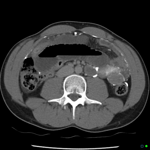 File:Chronic barium peritonitis and small bowel obstruction (Radiopaedia 29151-29548 D 7).jpg