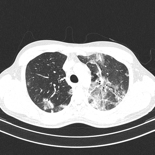 Chronic eosinophilic pneumonia (Radiopaedia 39331-41587 Axial lung window 15).png