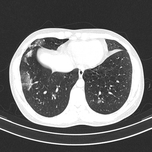 Chronic eosinophilic pneumonia (Radiopaedia 39331-41587 Axial lung window 41).png