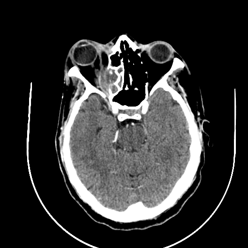Chronic invasive fungal sinusitis (Radiopaedia 91563-109286 B 37).jpg