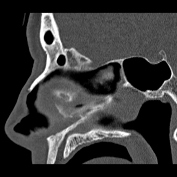 Chronic maxillary sinusitis (Radiopaedia 27879-28116 Sagittal bone window 28).jpg