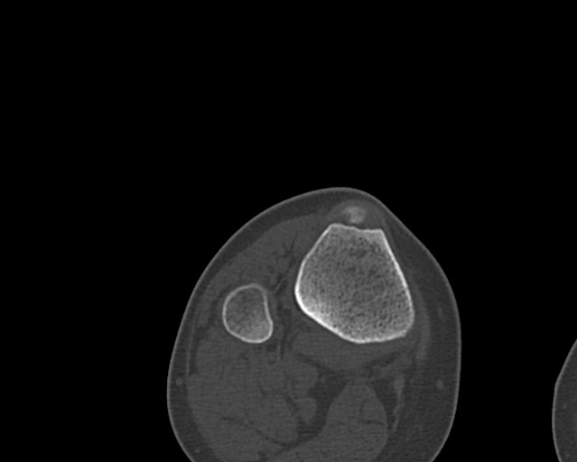 Chronic ostemyelitis of the femur with long sinus tract (Radiopaedia 74947-85982 Axial bone window 249).jpg