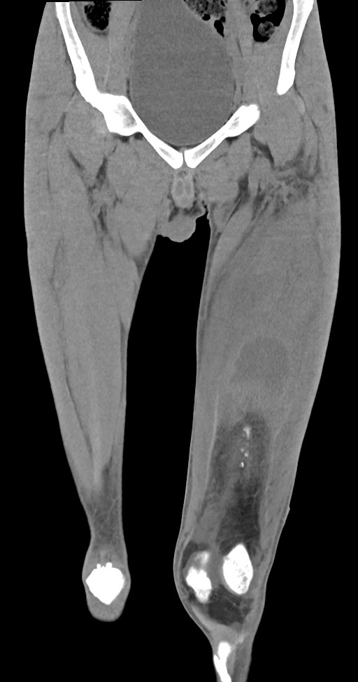 Chronic osteomyelitis (with sequestrum) (Radiopaedia 74813-85822 E 16).jpg